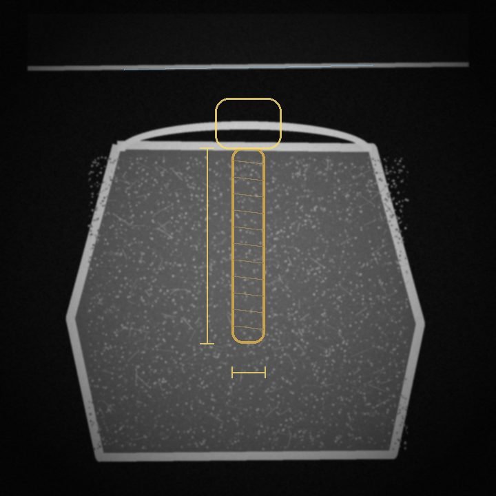 The same cross-section with the planned implant, crown envelope and safety margins overlaid