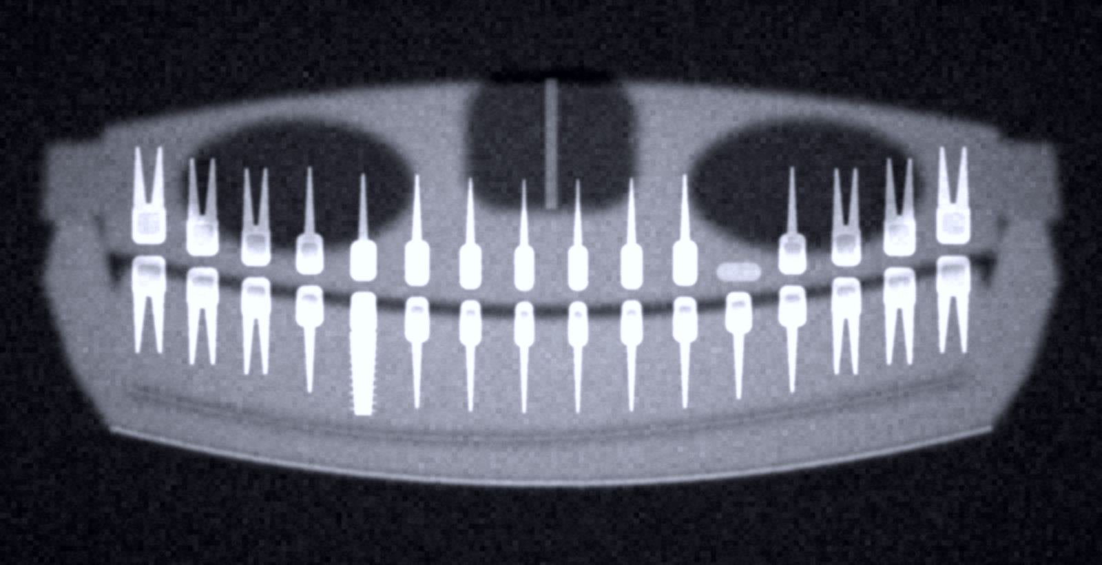 Panoramic dental radiograph showing both arches, the maxillary sinuses, the inferior alveolar nerve canal, a missing upper molar and an existing lower implant